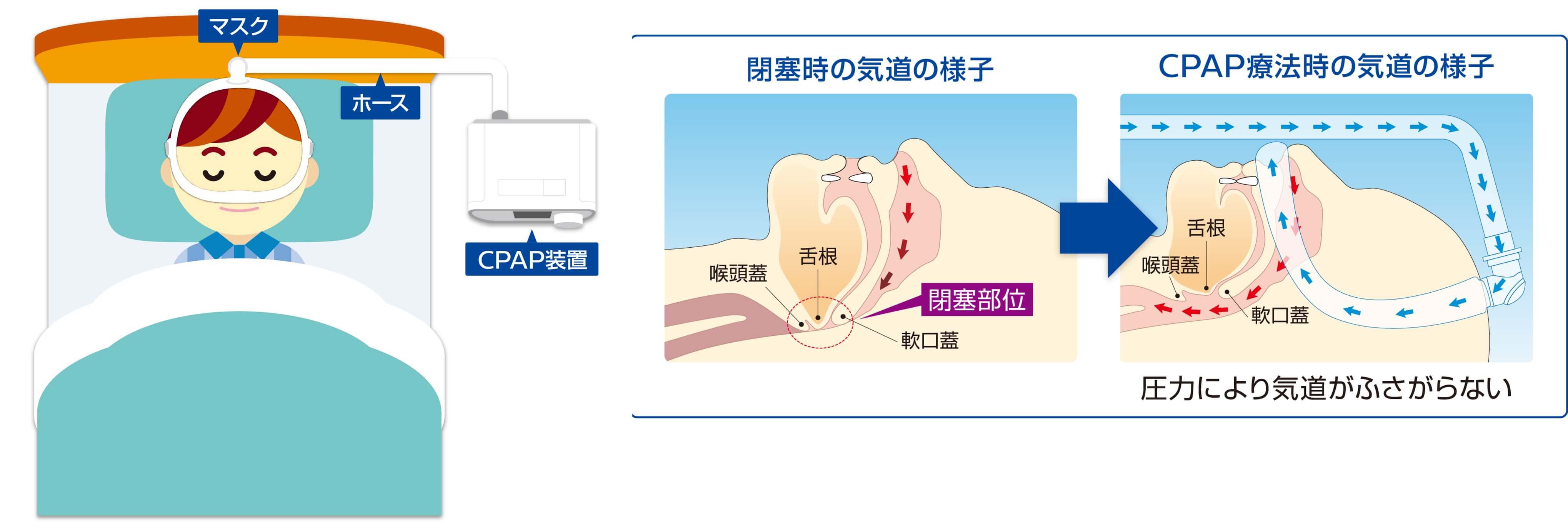 CPAP療法